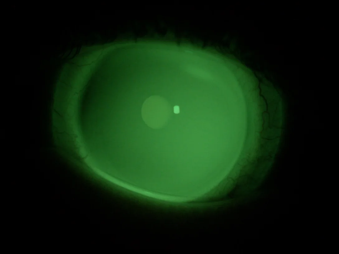 Lente a contatto con fluoresceina alla luce blu