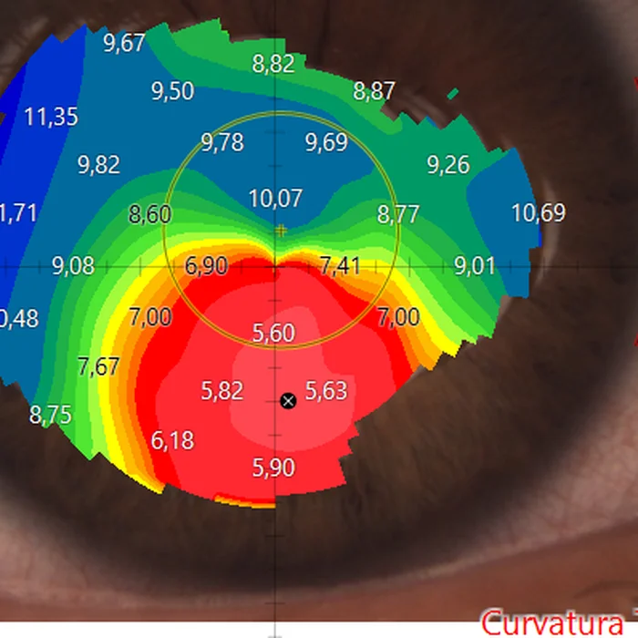 Topografia di una cornea con cheratocono